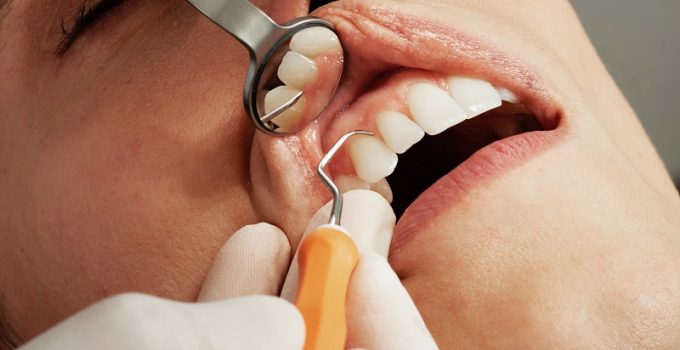 6 Signs That You May Have Gum Disease