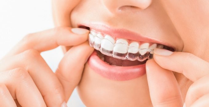 6 Tips To Get The Most From An Invisalign Treatment