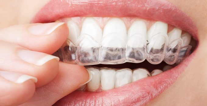 INVISALIGN®